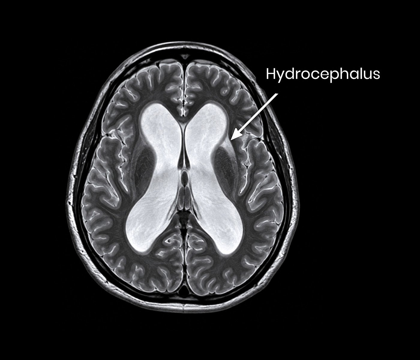 Hydrocephalus