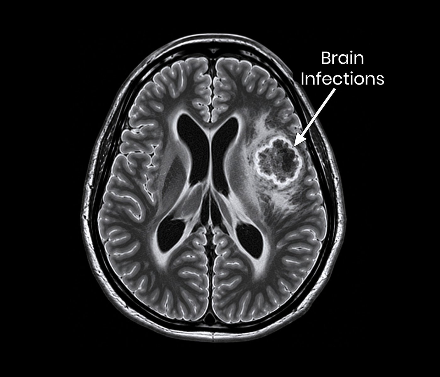 Brain Infections