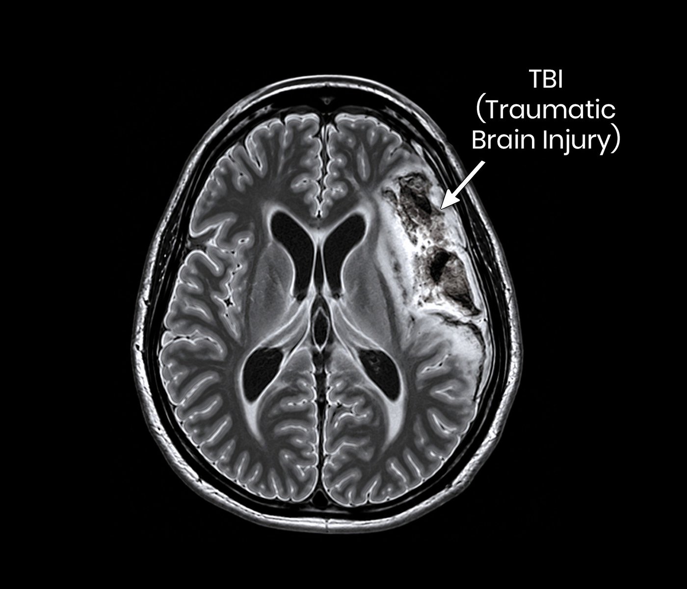 Traumatic Brain Injury