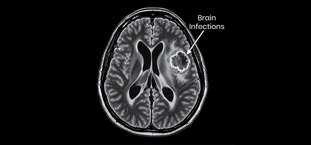 Brain Infections