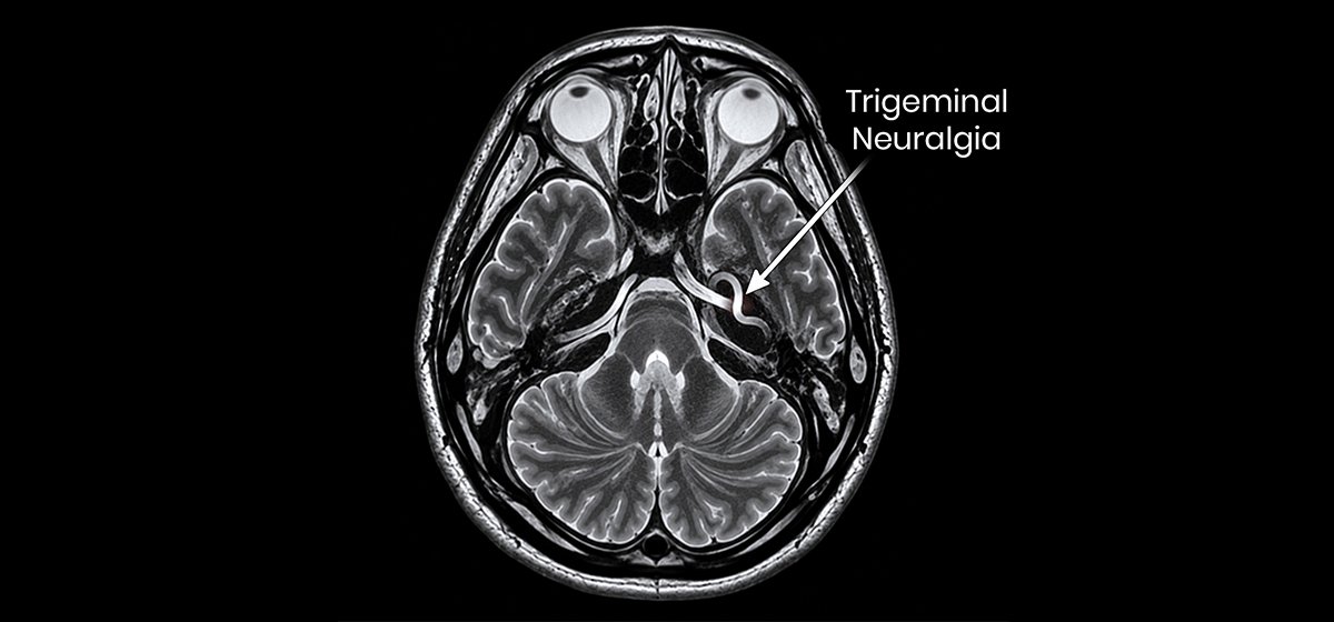Trigeminal Neuralgia