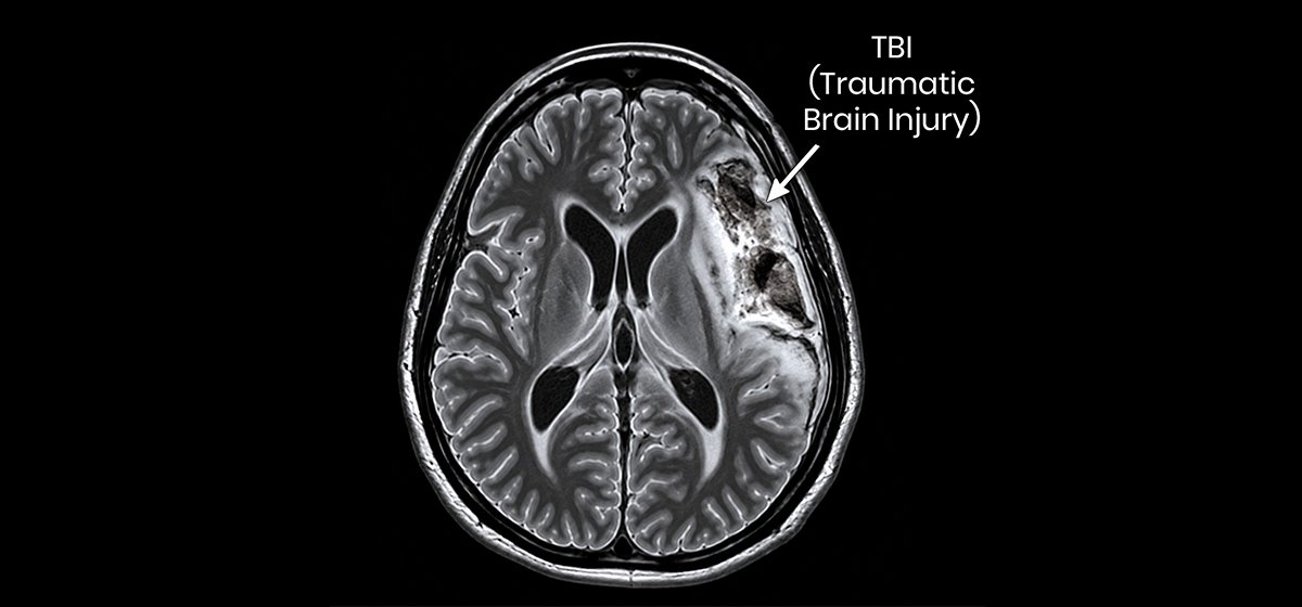 Traumatic Brain Injury