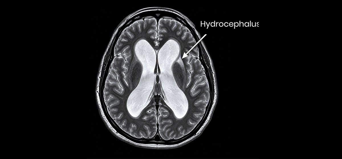 Hydrocephalus