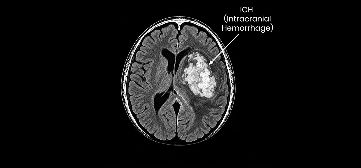 Intracranial Hemorrhage
