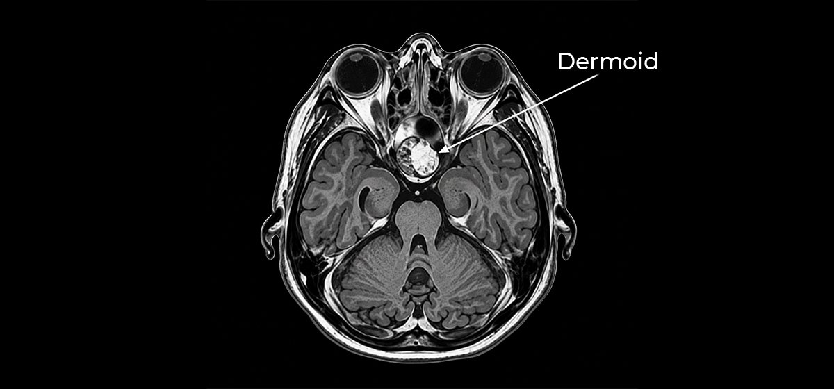Dermoid