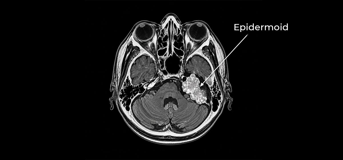 Epidermoid