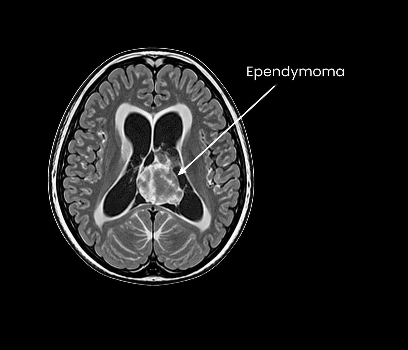 Ependymoma
