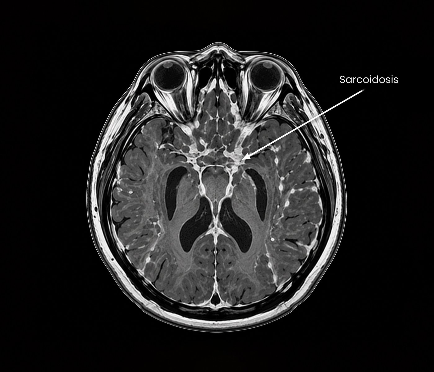 Sarcoidosis