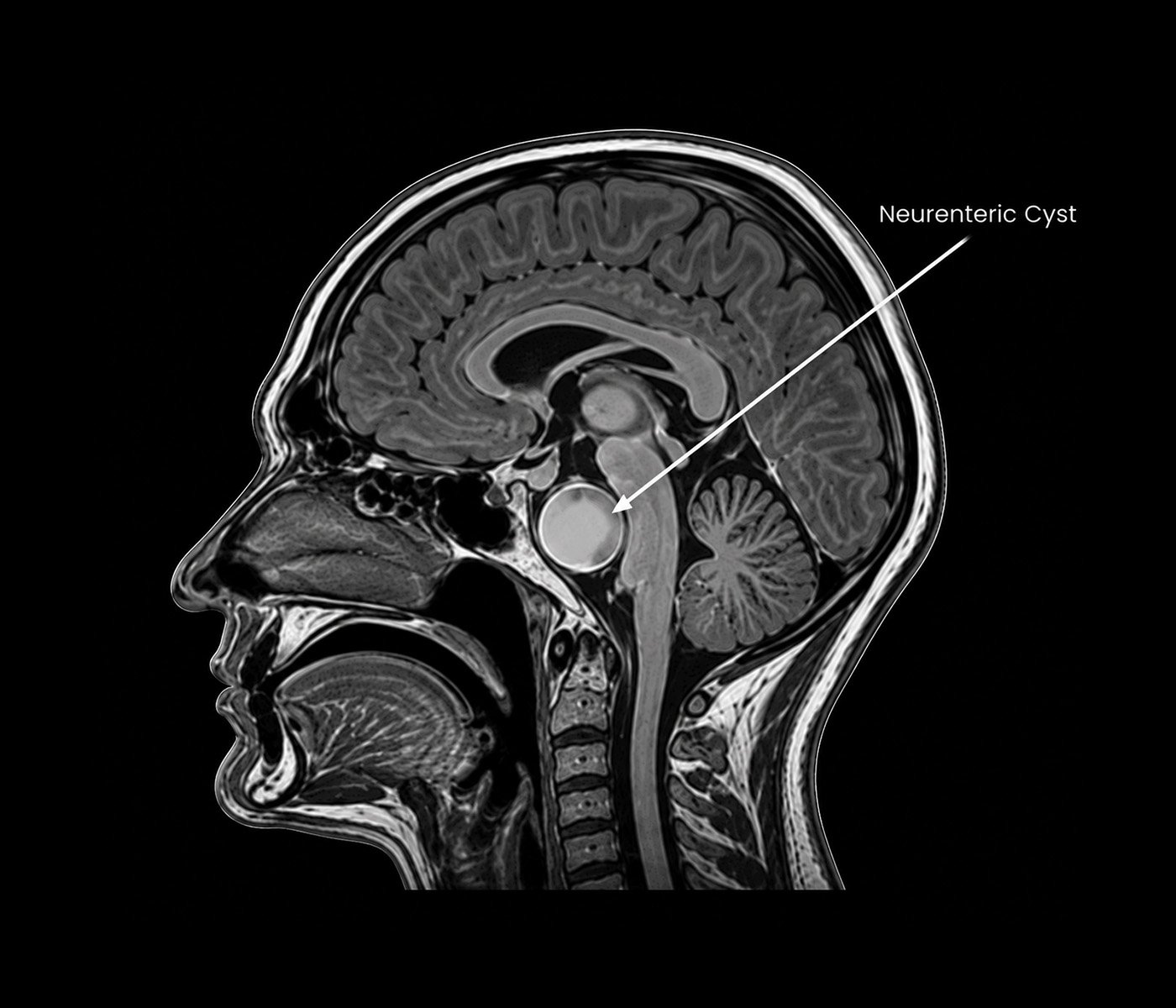Neurenteric Cyst
