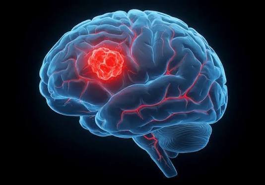 Brain Tumors